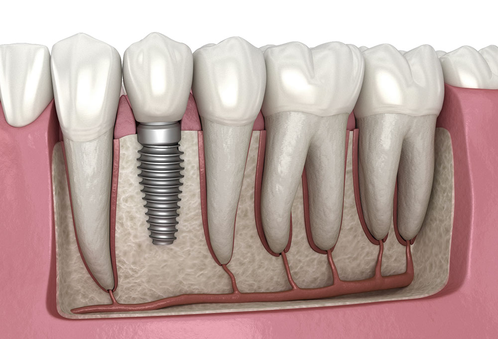 Dental implant illustration